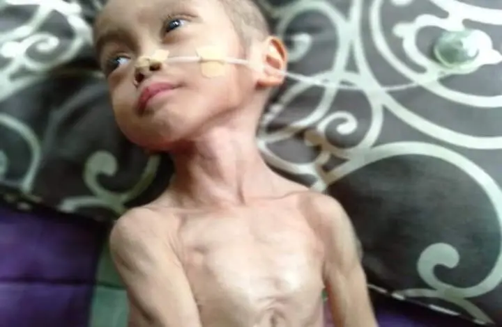 Bocah Dua Tahun di Cianjur Meningitis, Kondisinya Memprihatinkan