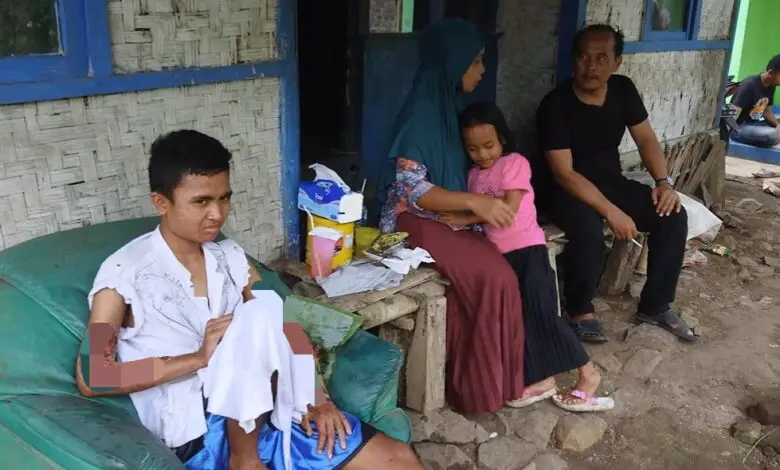 Cerita Sedih Asep, Tinggal di Rumah Reyod, Kedua Tangan Melepuh Terbakar
