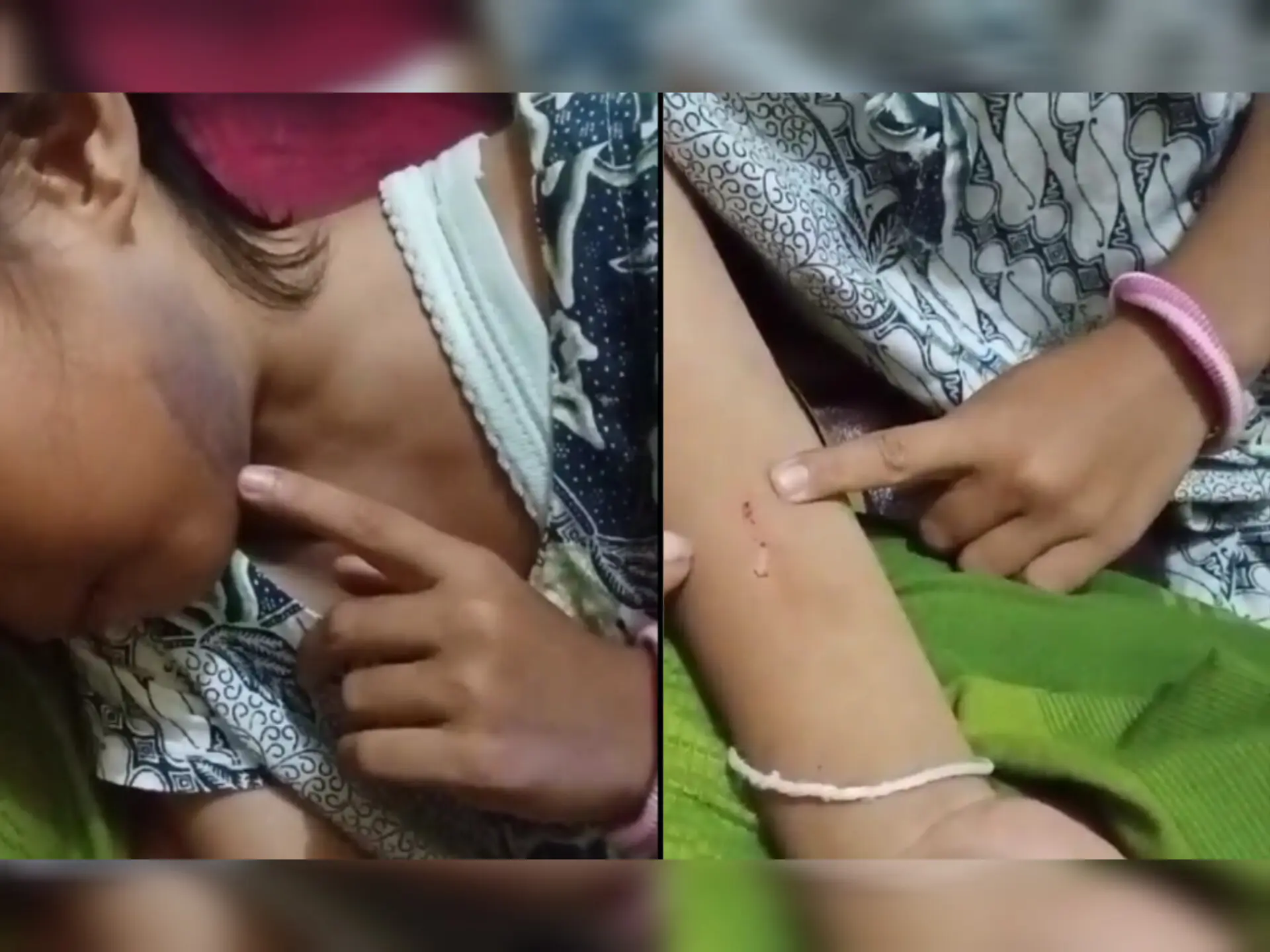 Disiksa Ibu Tiri, Anak Kelas 1 SD di Cianjur Penuh Luka dan Sempat Tidur di Luar Rumah