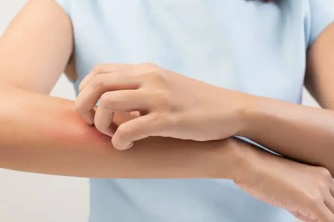 Mengapa Tubuh Bisa Merasakan Gatal? Simak Penjelasan dan Cara Menyembuhkannya!