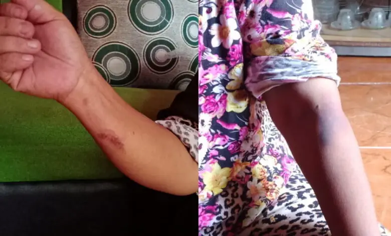 Seorang Ibu di Cibeber Diduga Disiksa Menantu dan Anak hingga Memar