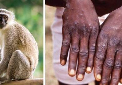 cacar monyet. sumber foto: internet