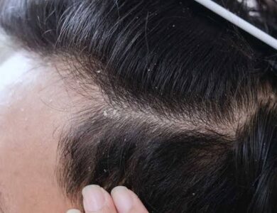 6 Cara Menghilangkan Ketombe Kering Paling Ampuh Tanpa Ribet