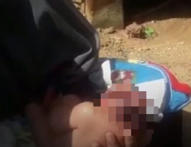 Duh, Bayi Perempuan di Sukabumi Idap Anensefali, Apa Itu?