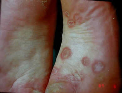 Waspada! Lonjakan Kasus Sifilis di Cianjur: Jangan Gonta-Ganti Pasangan!